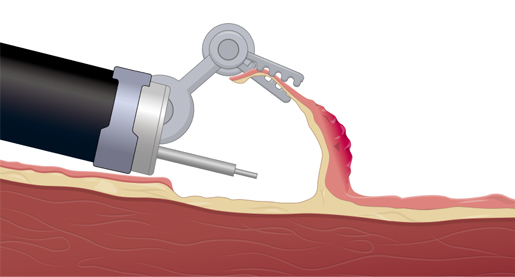 Robotic Endoscopic Submucosal Dissection